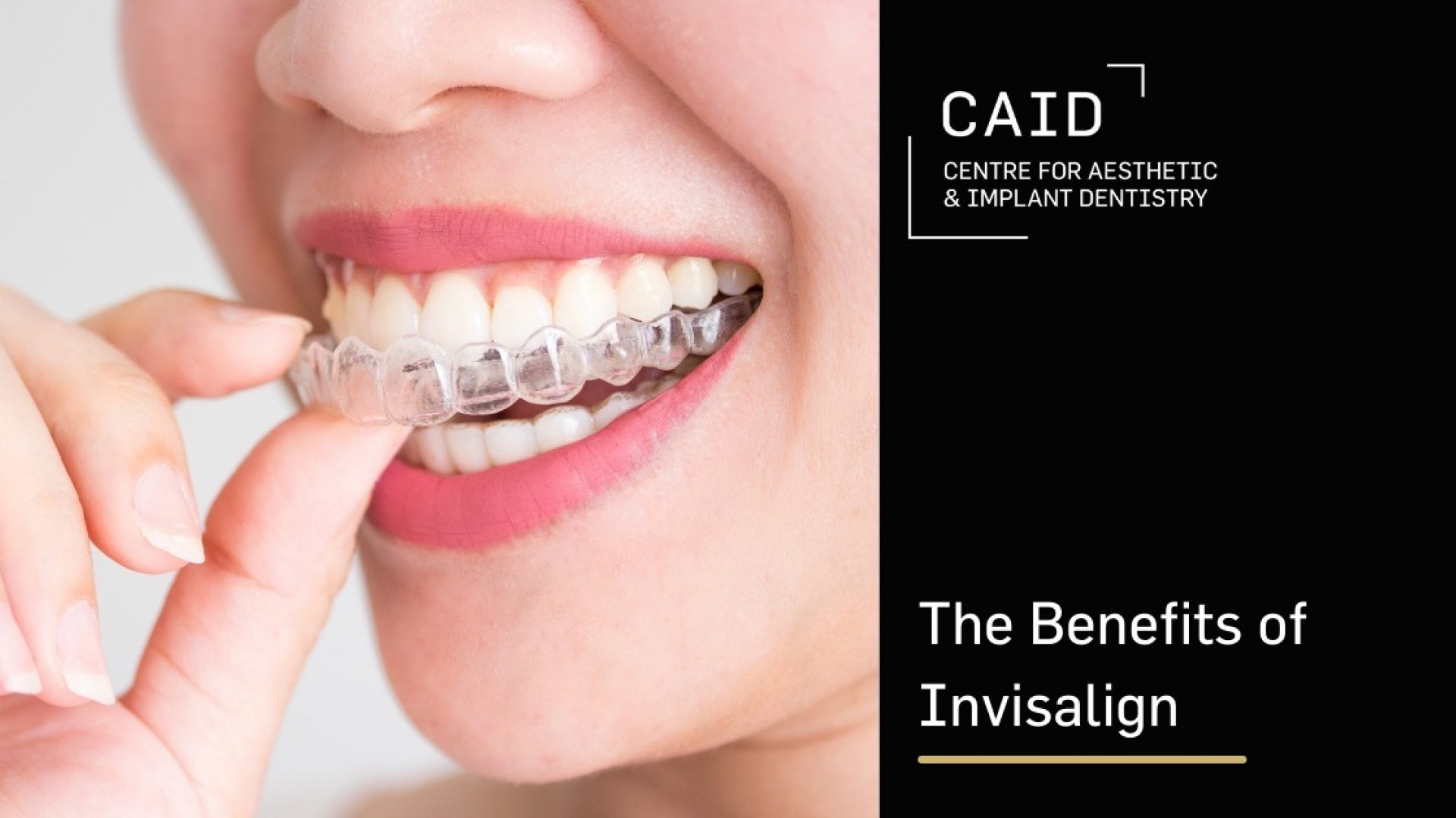 The Benefits of Invisalign®
