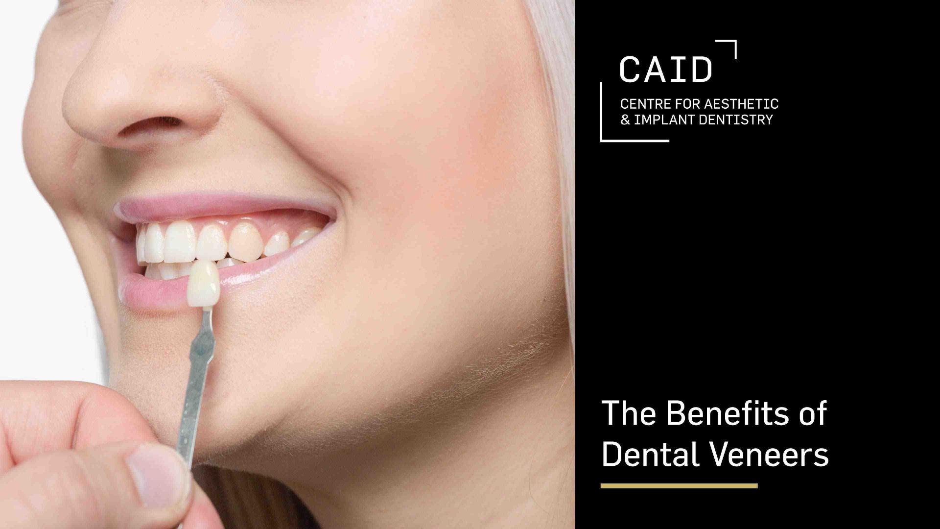 The Benefits of Dental Veneers